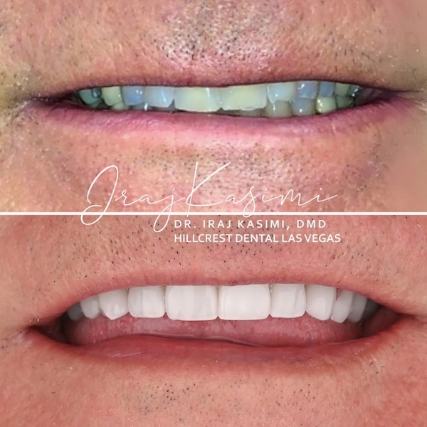 Full mouth reconstruction in Las Vegas, NV