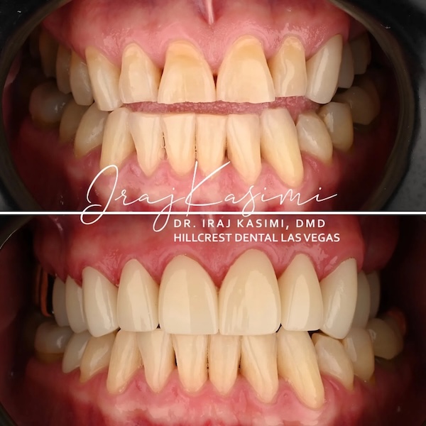 Full mouth reconstruction in Las Vegas, NV